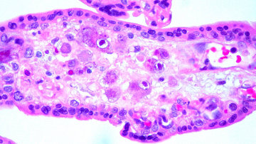 Cytomegalovirus